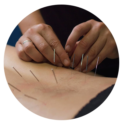 Dry Needling